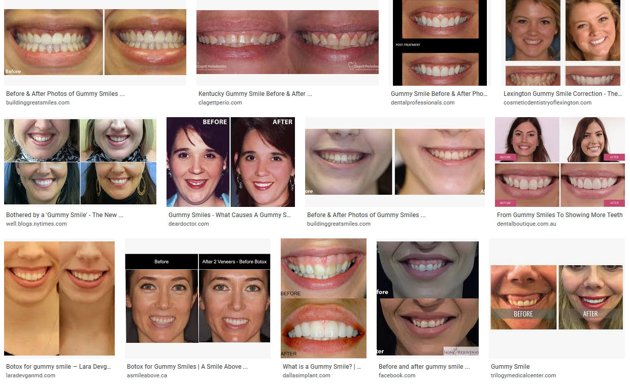 Gummy Smile before and after